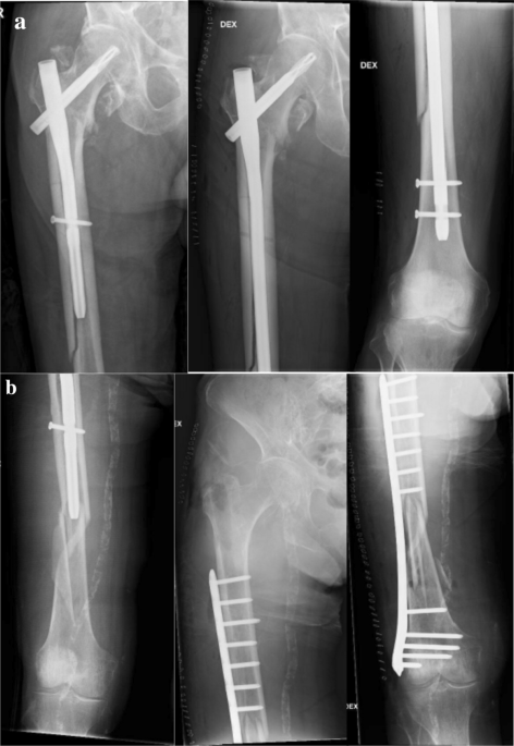 Peri-implant fracture: a rare complication after intramedullary fixation of  trochanteric femoral fracture | Archives of Orthopaedic and Trauma Surgery