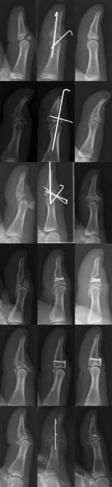 Surgical treatment of the bony mallet thumb: a case series and literature  review | Archives of Orthopaedic and Trauma Surgery