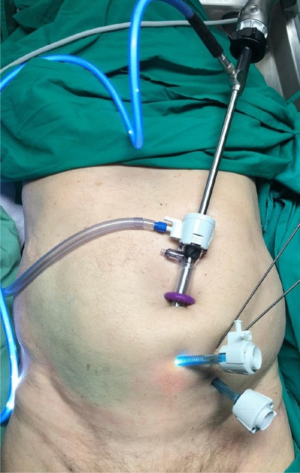 A novel implant removal technique by endoscopy, Journal of Orthopaedic  Surgery and Research