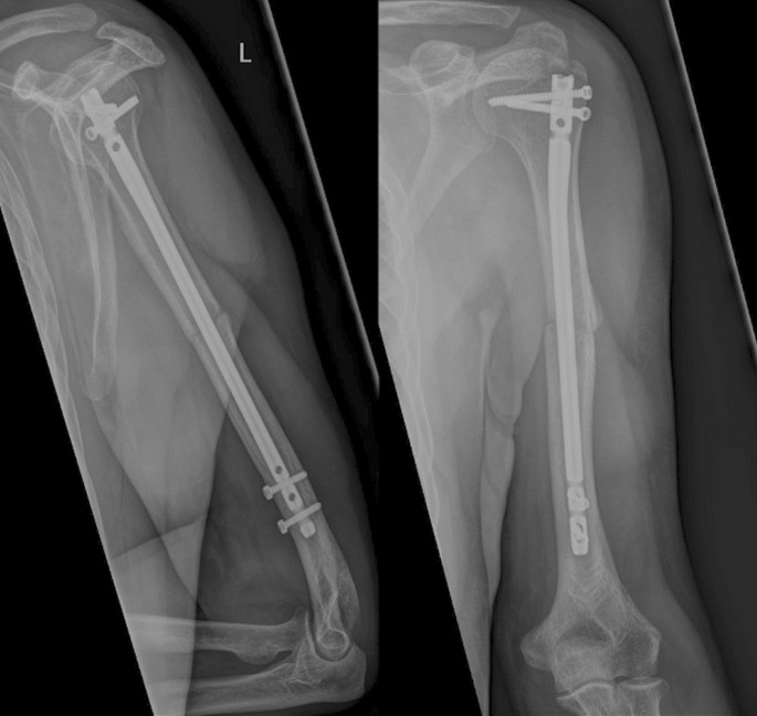 Tips and tricks in interlocking nailing in distal one third humerus shaft  and segmental fractures of humerus - IJOS