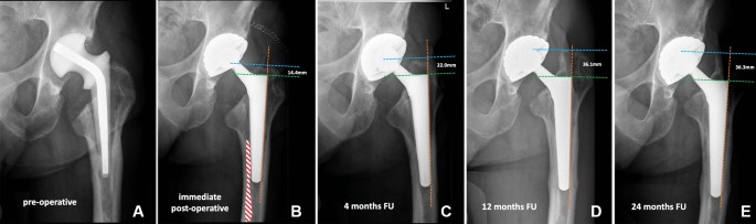 The use of a standard-length conical tapered stem in hip revision  arthroplasty to address Paprosky type I–II femoral defects: a prospective  study of 87 patients