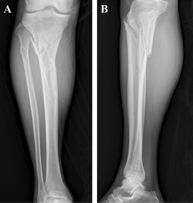 Suprapatellar versus infrapatellar nailing for tibial shaft fractures: A  comparison of surgical and clinical outcomes between tw