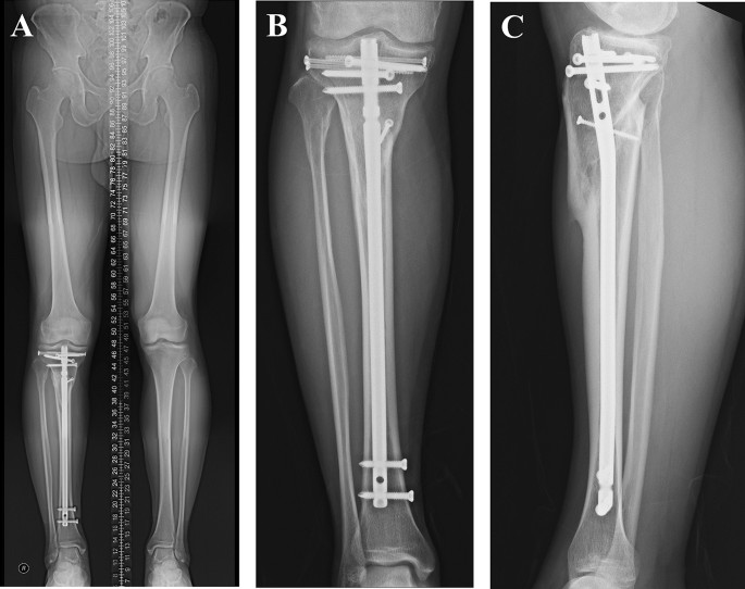 AAOS OVT - Semiextended Tibial Nailing Using the Modified Medial Arthrotomy