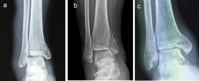 Ankle Fracture  Orthopaedic Trauma Association (OTA)