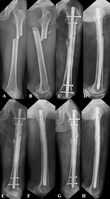 Elastic stable intramedullary nailing for severely displaced distal tibial  fractures in children. - Abstract - Europe PMC