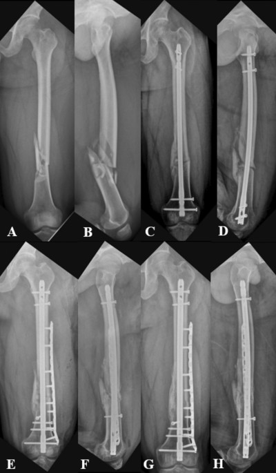 Plate augmentation leaving the nail in situ and bone grafting for non-union  of femoral shaft fractures | International Orthopaedics