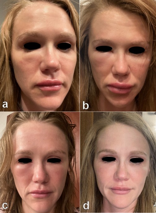 Late inflammatory complication 20 years after filler application