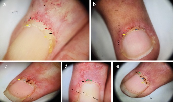 Nailfold Changes as a Sign of Underlying Systemic Illnesses