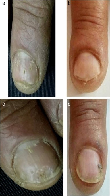 Signs & Symptoms of Psoriasis - Trillium Creek Dermatology