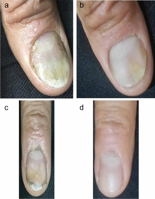 Psoriasis Of The Feet Treatment [Causes, Symptoms & Best Treatment]