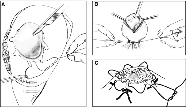 PURSE-STRING SUTURING TECHNIQUE – Katsan Tıbbi Cihazlar