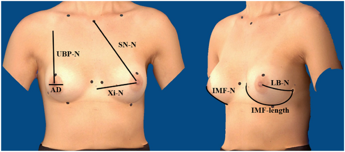 Surgery of congenital breast asymmetry—which objective parameter
