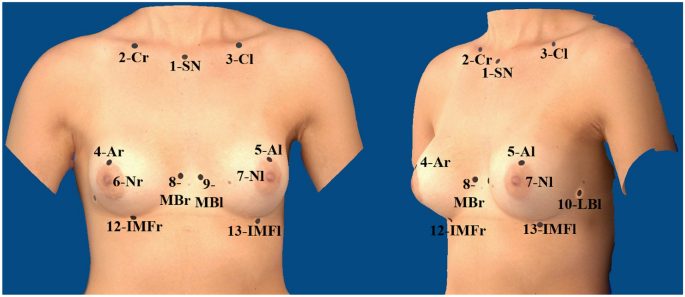 Surgery of congenital breast asymmetry—which objective parameter influences  the subjective satisfaction with long-term results
