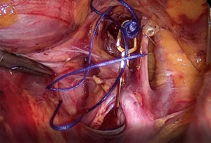 Photographs from laparoscopy showing: (A) internal bleeding measuring