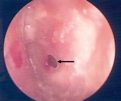 Paper-patch myringoplasty with CO2 laser for chronic TM perforation |  European Archives of Oto-Rhino-Laryngology