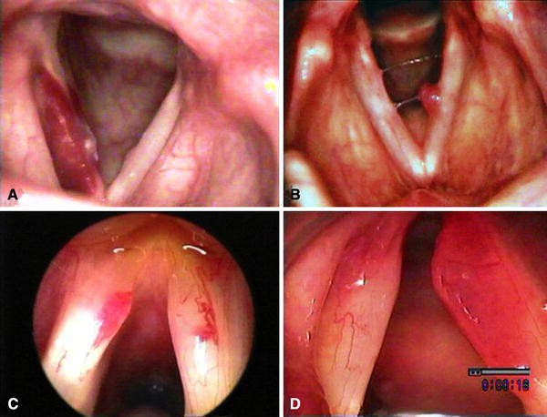 Vascular lesions of the vocal fold | European Archives of  Oto-Rhino-Laryngology