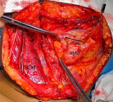 Marginal Mandibular Nerve Weakness (Ramus Mandibularis) - Level I Neck  Dissection (extended) recurrent pleomorphic adenoma - Clinical case example