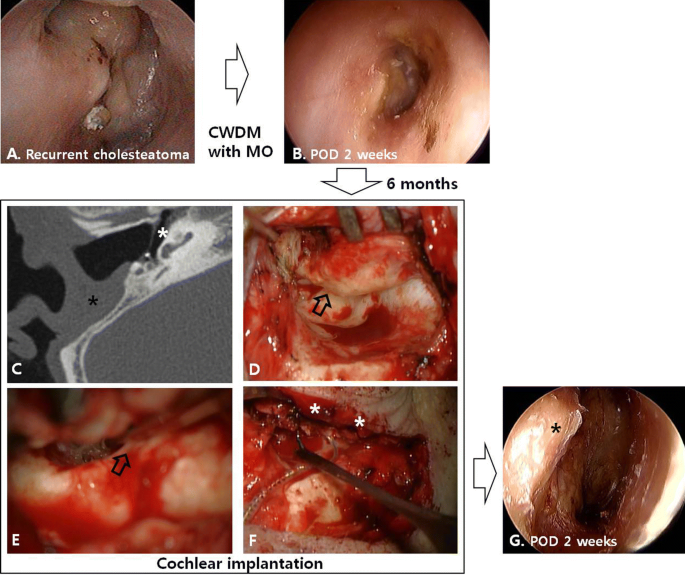 Tympanosclerosis – Oto Surgery Atlas
