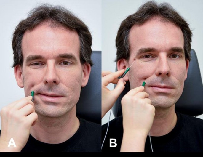 Facial nerve electrodiagnostics for patients with facial palsy: a