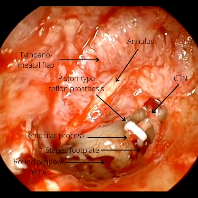 Stapes Surgery