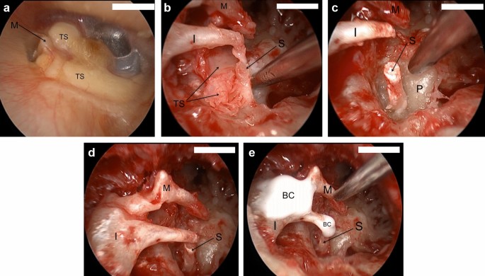 Tympanosclerosis – Oto Surgery Atlas