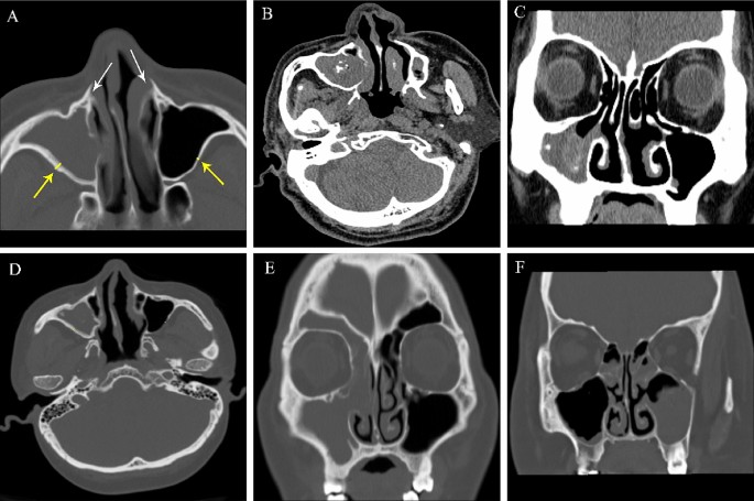 Clinical features in maxillary sinus fungus ball in patients with malignant  hematological disease | European Archives of Oto-Rhino-Laryngology