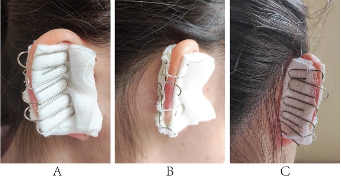 Using paper clips to make simple, effective, and accessible auricular  compression devices