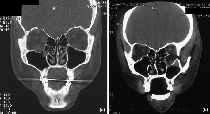 Orbital Floor Fractures A Comparison Between Ct Images And Findings At Surgery European Archives Of Oto Rhino Laryngology