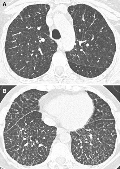 Bone marrow involvement in Niemann Pick disease - 1.