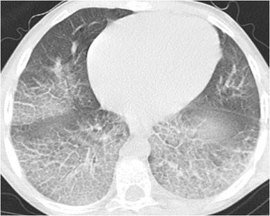 Niemann-Pick disease type B: HRCT assessment of pulmonary