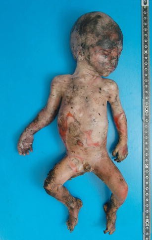 Postmortem “delivery” in a pregnant fire victim ...