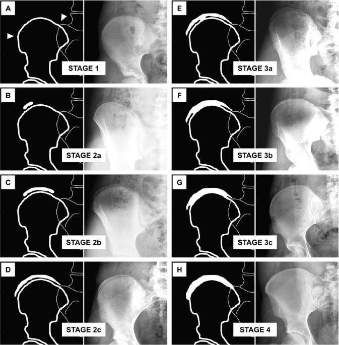 The iliac crest in forensic age diagnostics: evaluation of the apophyseal  ossification in conventional radiography
