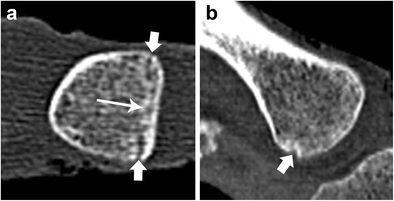 The iliac crest in forensic age diagnostics: evaluation of the apophyseal  ossification in conventional radiography