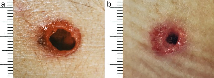 Differing sizes of bullet entrance holes in skin of the anterior and  posterior trunk | International Journal of Legal Medicine