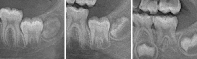 Improving reliability of permanent tooth staging for dental age estimation using the crown–root ratio method - International Journal of Legal Medicine