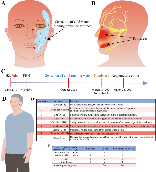 A man with sensation of cold water running down the face | Journal of  Neurology
