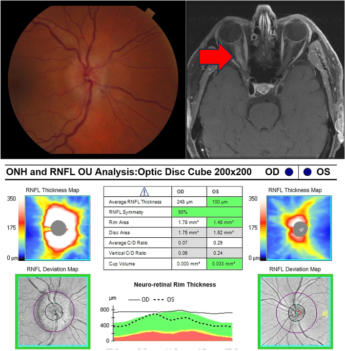 An update on optic neuritis | Journal of Neurology