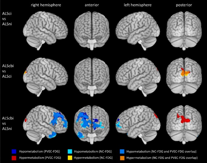 Cerebral glucose metabolic correlates of cognitive and behavioural impairments in amyotrophic lateral sclerosis