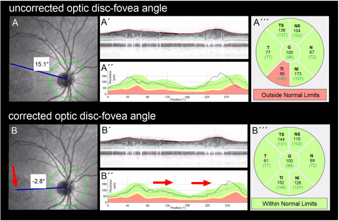 Study links drinking coffee and tea to increased macular retinal nerve  fiber layer thickness