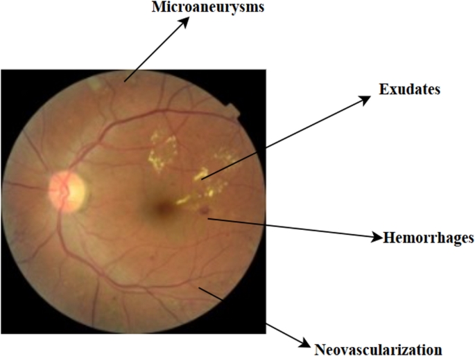 Synthetic data-driven diabetic retinopathy diagnosis with explainable AI: a clinically interpretable framework
