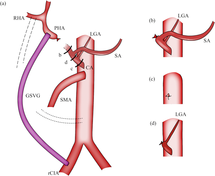 Clinical usefulness of saphenous vein graft in major arterial  reconstruction during extended pancreatectomy | Langenbeck's Archives of  Surgery