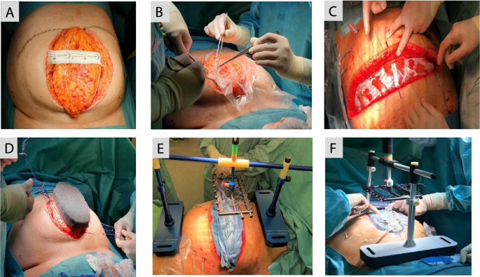 Figure S. Different devices for temporary abdominal closure for planned