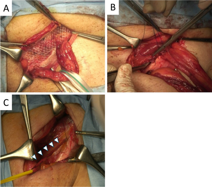 Inguinal Hernia Surgery - Treatment, Diagnosis & Repair - MH Surgery Clinic