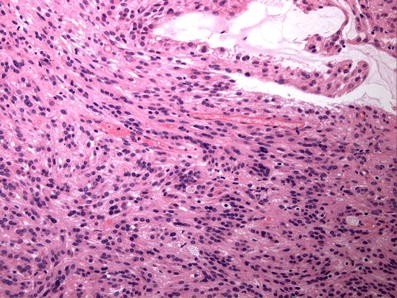 Psammomatous melanotic schwannoma presenting as colonic polyps | Virchows  Archiv