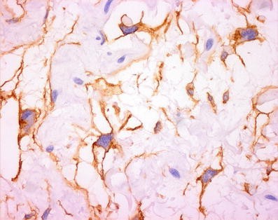 JCDR - Floret giant cells, Ropey collagen, Soft tissue neoplasm