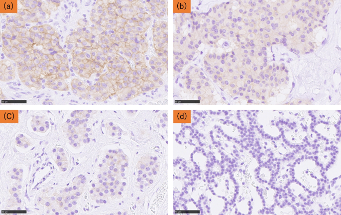 glp 1 neuroendocrine tumor GLP- 1R status using validated monoclonal antibody in 689 cases of neuroendocrine  neoplasm and its correlation with somatostatin receptor scintigraphy,  insulin production, and histological grades | Virchows Archiv