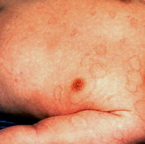 Acute myeloid leukaemia presenting as recurrent generalized urticaria in  infancy | European Journal of Pediatrics