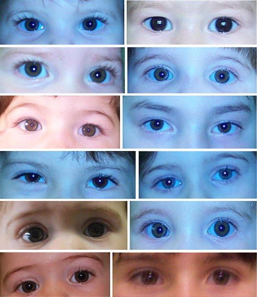 Triple X syndrome: characteristics of 42 Italian girls and parental  emotional response to prenatal diagnosis | European Journal of Pediatrics