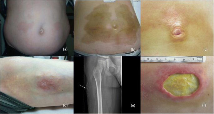 tirzepatide skin reaction Injection site reactions after long-term subcutaneous delivery of  drisapersen: a retrospective study | European Journal of Pediatrics