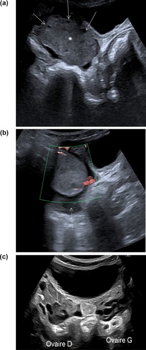 Ovarian and fallopian tube torsion - UpToDate